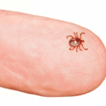 Febre Maculosa